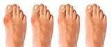 The Bunion Relief and Forefoot Protector Brace "Pair"