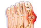 The Bunion Relief and Forefoot Protector Brace "Pair"